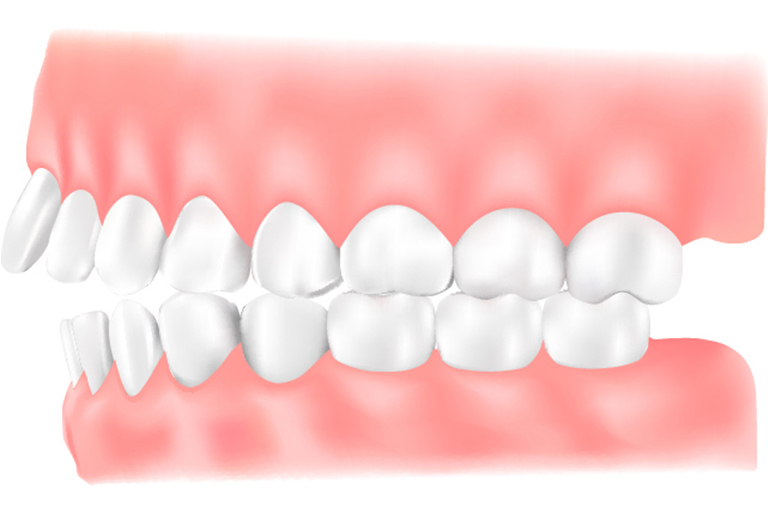 出っ歯（上顎前突）