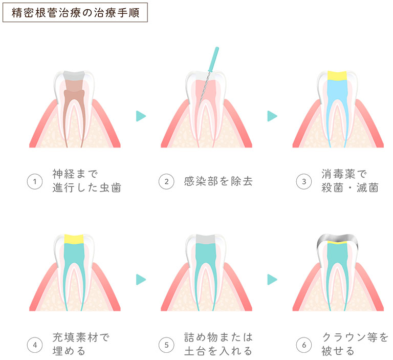 精密根管治療の治療手順